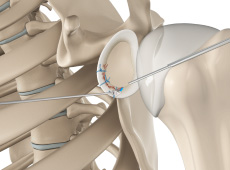 Arthroscopic Bankart Repair