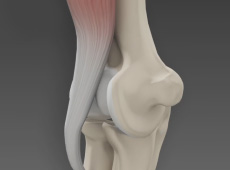Biceps Tendon Rupture