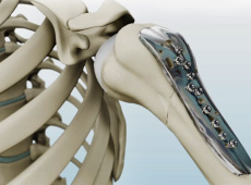 Shoulder Fracture Surgery