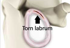Shoulder Labrum Tear