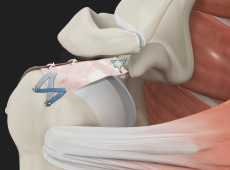 Superior Capsule Reconstruction